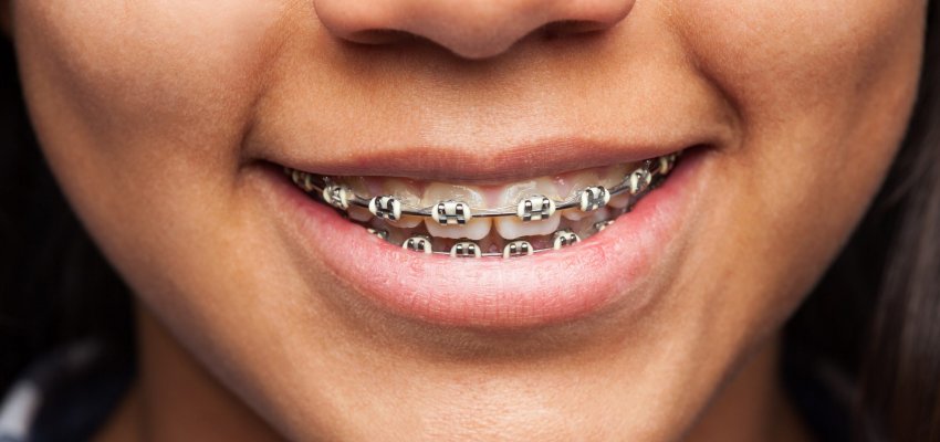 latin girl's mouth with brackets